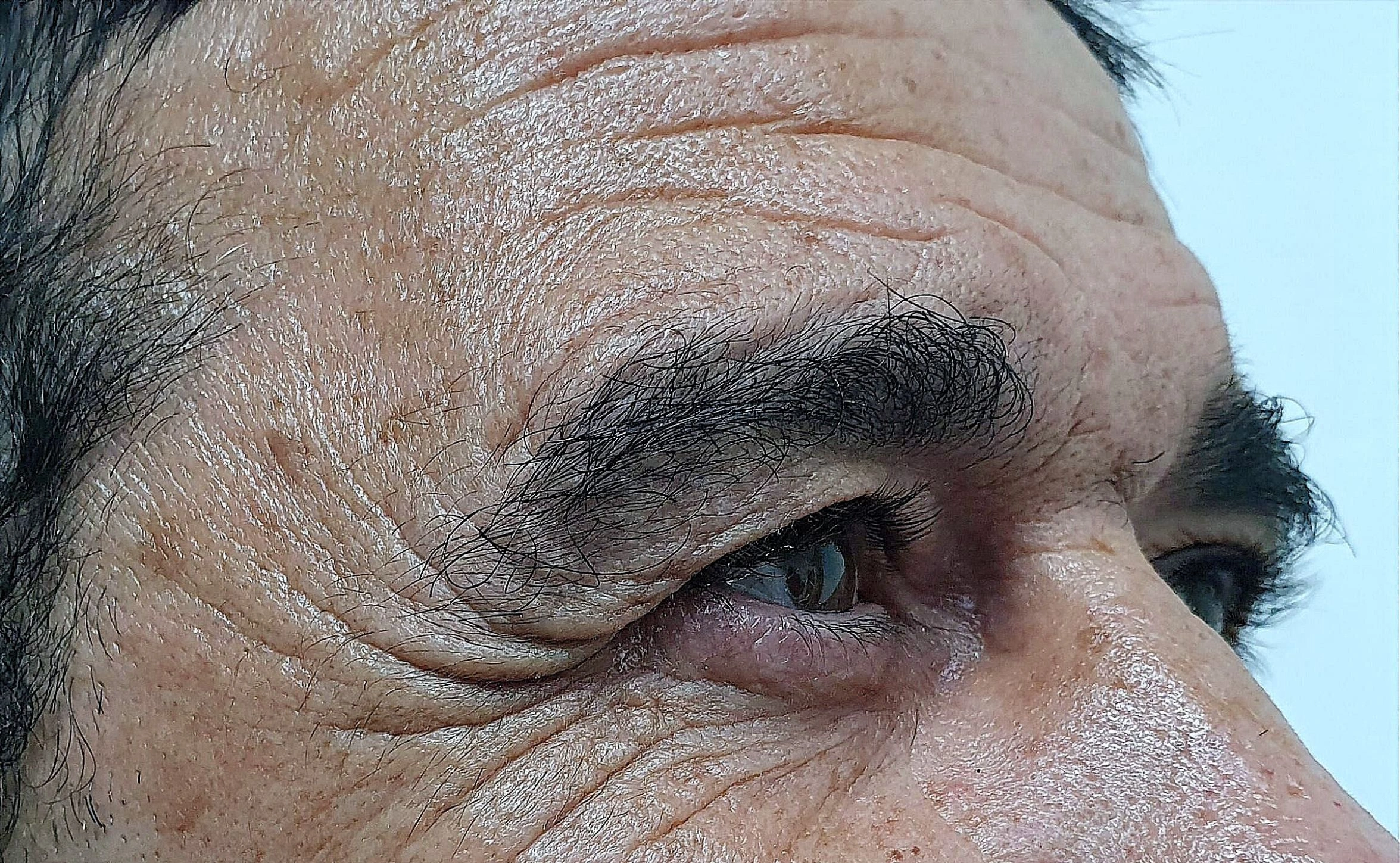 Botox antes. marcadas arrugas. Lado derecho