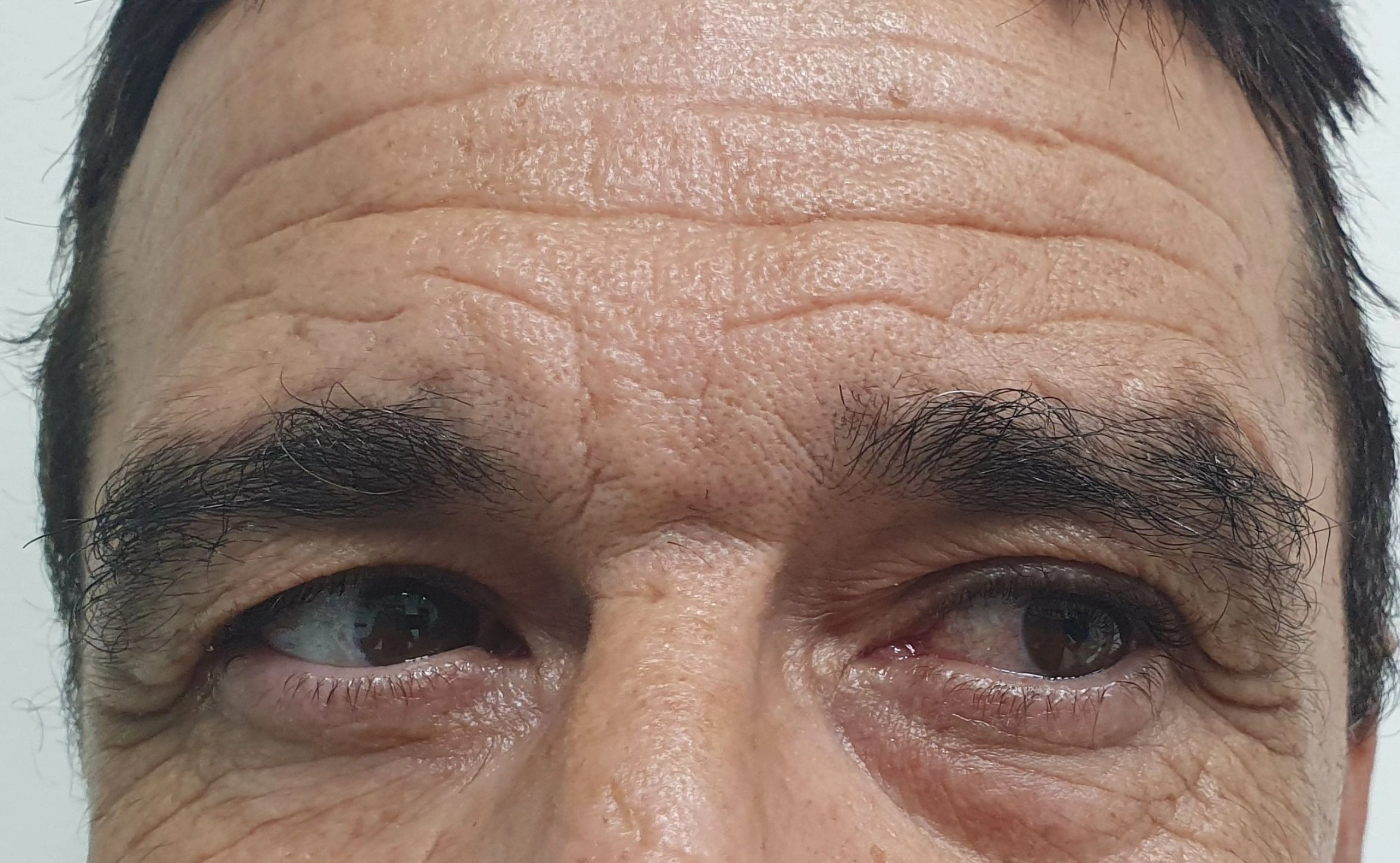 Botox antes. marcadas arrugas. frente