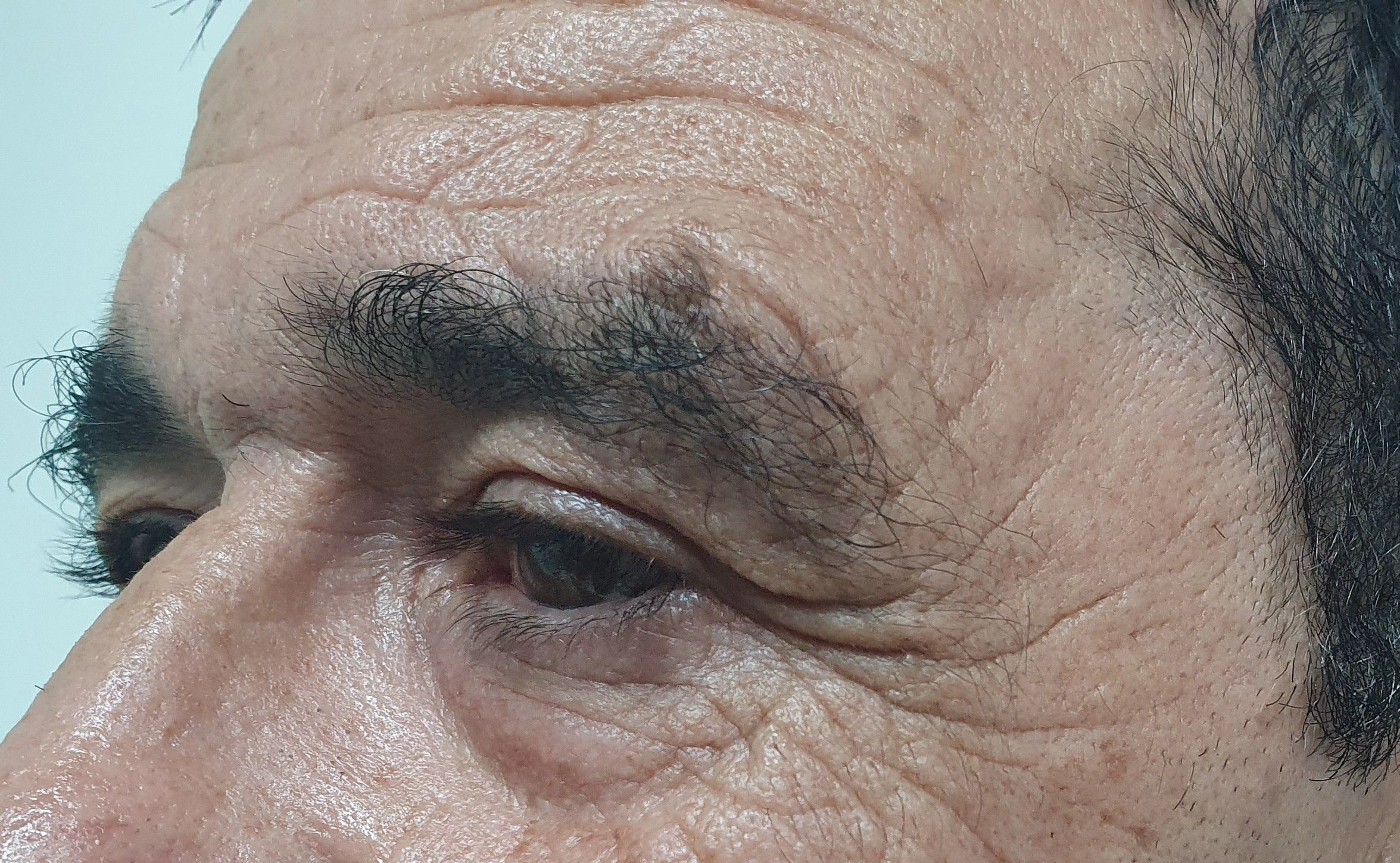 Lado izqu Botox antes. marcadas arrugas. frente. lado izquierdo